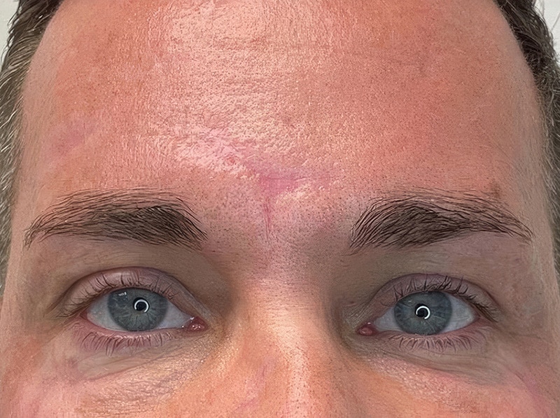 6 a Scar Removal
