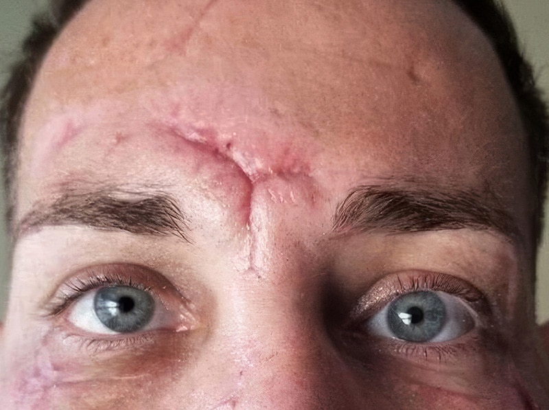6 b Scar Removal
